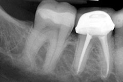 x-ray of teeth after root canal