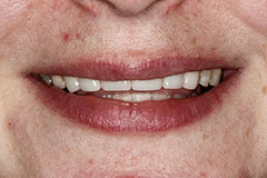 whitened teeth after color correction
