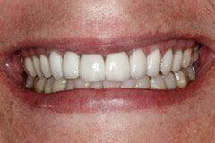 smile after gum contouring
