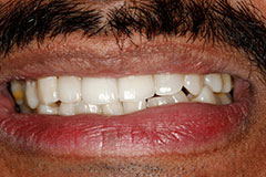 Man's tooth after veneer placement