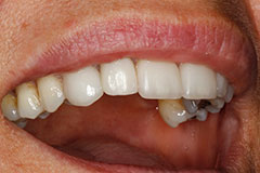 smile with dental implant placed
