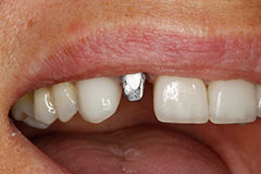 smile with silver implant