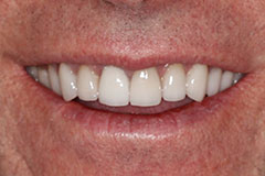 man's smile with whitened teeth