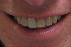 man's smile before professional whitening