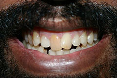 man's smile with discolored front teeth