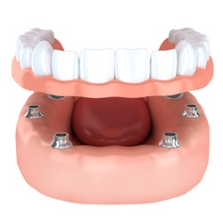 computer illustration of Implant-retained dentures