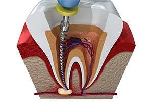 computer illustration of a root canal