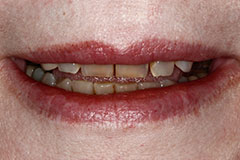 highly discolored front teeth