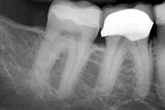 X-ray of teeth before a root canal