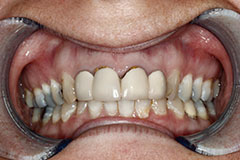 teeth before gum contouring