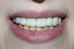 teeth corrected with porcelain veneers
