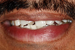 Man's chipped tooth before veneers