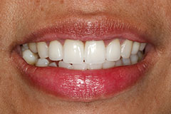 woman's teeth corrected with veneers