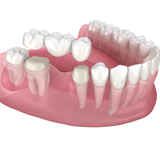 Illustration of traditional dental bridge being placed on teeth
