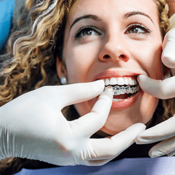 Owings Mills dentist placing Invisalign on patient
