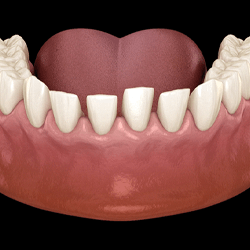 Illustration of gaps between teeth