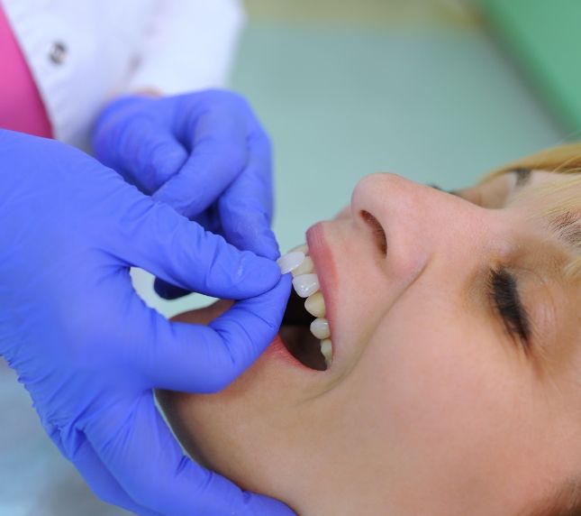 Placing veneers on female dental patients teeth