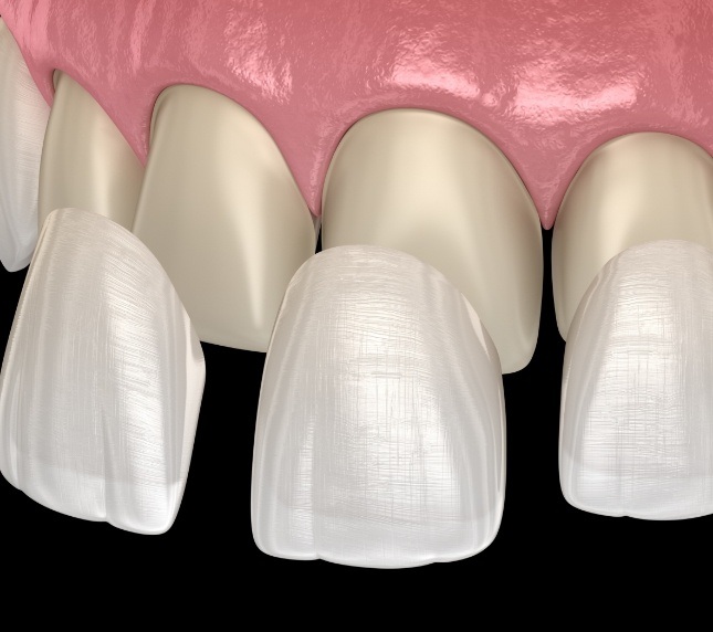 Illustration of Lumineers being placed on teeth