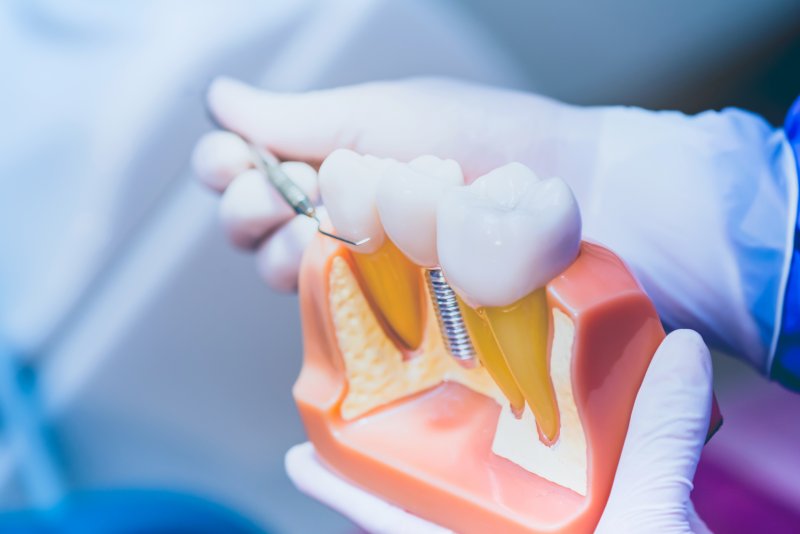 Gloved hand pointing at model of dental implants