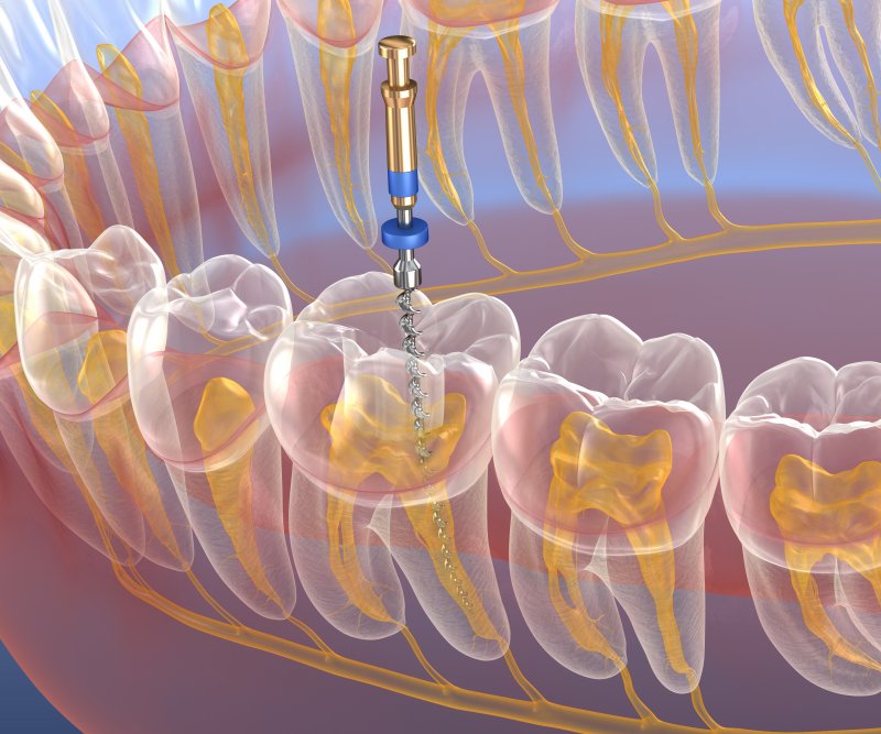 Illustration of the root canal therapy process
