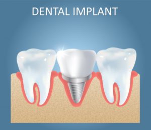 3D illustration of dental implant 